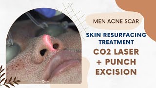 Men Acne Scar Skin Resurfacing Treatment CO2 Laser  Punch Excision West HollywoodDr Jason Emer [upl. by Beore]