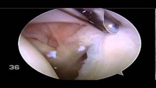 Labral Debridement to Treat Shoulder Socket Labrum Tear  Dr Steven Struhl [upl. by Aicssej]