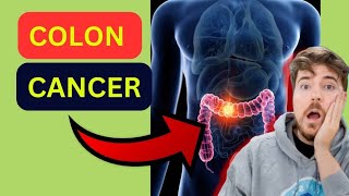 How does colon cancer look like What iscolorectal cancer [upl. by Kravits]