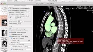 Generating 3D models using Osirix [upl. by Tevlev905]