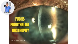 What is Fuchs Endothelial Dystrophy Eye Dr Explains 2023 [upl. by Amrak722]