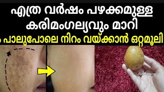 കരിമംഗല്യം മാറാൻ ഇതിനേക്കാൾ നല്ല വഴി ഇനി സ്വപ്നങ്ങളിൽ മാത്രംbest treatment for pigmentation on face [upl. by Oker]