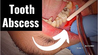 Incision and Drainage of Tooth Abscess Draining Pus [upl. by Stone]