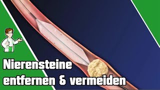 Nierensteine entfernen und vermeiden  SO geht es 👨‍⚕️ [upl. by Nilorac635]