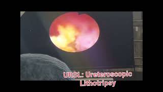 URSL Ureteroscopic Lithotripsy [upl. by Ahsas]