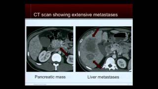 Tumor Board Case Discussions Neuroendocrine Tumor Patient Education Conference [upl. by Genesa]