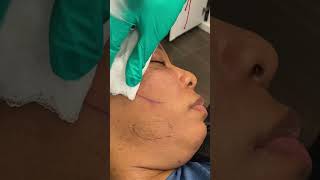 Acne Scar Subcision [upl. by Nidya]