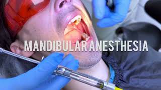 Techniques for Mandibular Anaesthesia  VaziraniAkinosi Mandibular Block Technique dentist dental [upl. by Ailima264]