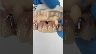 Clasping to the Canines EnvisiontecMain envisiontec lsk121shorts dentist teeth [upl. by Emolas669]