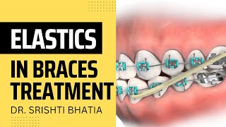 ELASTICS in Braces Treatment Dr Srishti Bhatia [upl. by Anerda]