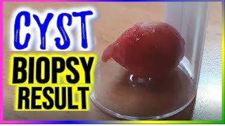 Sebaceous Cyst Excision  Biopsy Result  April 2024 [upl. by Lola]