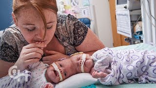 Conjoined Twins Abby and Erin Delaney A Year in the Life [upl. by Laehcar]