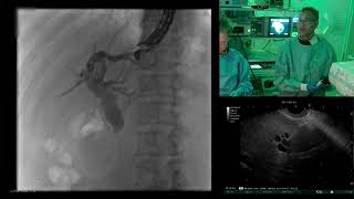 LCIE EUS guided antegrade biliary drainage  How I do it [upl. by Aleck]