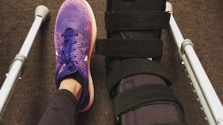 Tibia and Fibula Break 1 month after [upl. by Olwen]