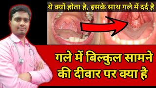 Granular Pharyngitis गले में लाल लाल दाने दिखाई देना Throat Infection In Hindi Throat Problems [upl. by Lorien]