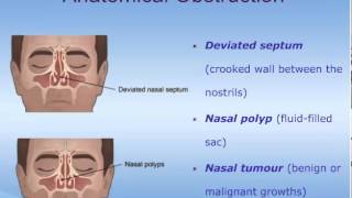 The Pathophysiology of Rhinosinusitis [upl. by Fredelia]