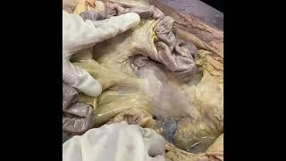 Small Intestine and Mesentery  Dissection StepbyStep 🧠AnatomyD MBBSStudentsDissectionTutorial [upl. by Gorrono490]