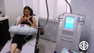 CoolSculpting to Lower Abdomen [upl. by Annawoj]