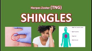 Shingles Management Risk Factor Infection and Treatments [upl. by Neukam690]