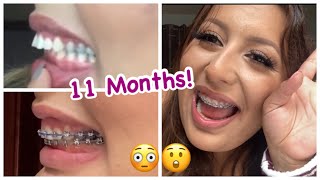 11 Months With Braces  Overjet Correction With No Extractions  Damon Braces [upl. by Leunamnauj]