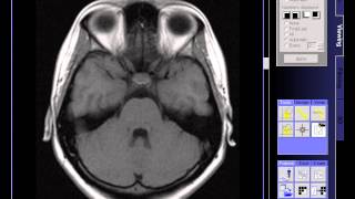 BRAIN MRI WITHOUT CONTRAST [upl. by Ailin]