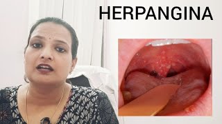 HERPANGINA throat ulcers in kids with high fever precautions and treatment [upl. by Ardell]