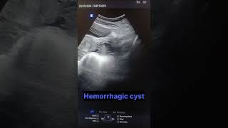 left ovarian hemorrhagic cyst radiological cases [upl. by Anitsyrhc]