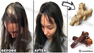 Mix cloves with ginger🌿 the Indian secret to make hair grow fast and treat baldness [upl. by Aserehc]