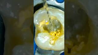 guttapercha Removal using Retreatment D1 D2  D3 Rotary files الكربولة [upl. by Jermayne]