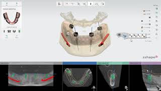 3Shape Implant Studio  Caso de Edentados  Como realizar o planejamento de implante [upl. by Annehs]