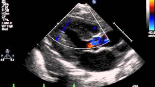 How to do pediatric echocardiography study [upl. by Attenod]