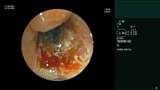 Pulmonary Mucormycosis  Bronchoscopy  Biopsy [upl. by Nahsor]