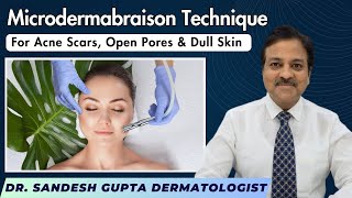 Microdermabrasion Technique for acne scars Open pores and dull skin  Treatment by Dermatologist [upl. by Hijoung]