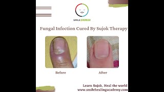 Fungal Infection of Nail Cured By Sujok Therapy [upl. by Etessil]