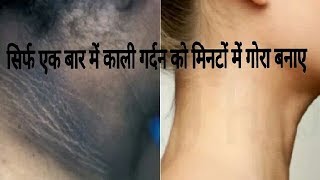 Skin Bleaching काली गर्दन को मिनटों में गोरा सुंदर बनाये  dark neck to fair [upl. by Iba562]