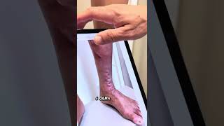 ECZEMA  VARIZES GROSSAS TRATAMENTO COM LASER ENDOVENOSO [upl. by Tamis]