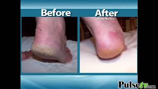 Heel Tastic  Dry Cracked Heel Foot Balm [upl. by Aldridge90]