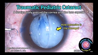 CataractCoach™ 2254 traumatic pediatric cataract [upl. by Deth442]