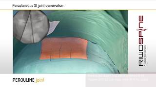 PERCULINE joint  interventional percutaneous SIjoint denervation [upl. by Avla521]