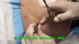 20Minute Abscess Removal Popping Zits Cysts Infections amp Pimples 👍 [upl. by Terryn]