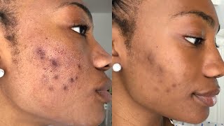 CLEARING UP ACNE SCARRING amp HYPERPIGMENTATION [upl. by Ahsitaf687]