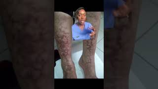 Toasted Skin Syndrome Erythema ab igne Explained [upl. by Norab799]