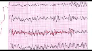 Fibrilación Ventricular vs Torsades de pointes EKG [upl. by Rosemary]