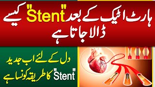 Heart Stent Procedure  Heart Stent Kaise Dalte Hain  Heart Attack Stent Procedure [upl. by Dugald]