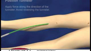 Scanlan Vascular Tunneling System [upl. by Naylor]