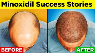 MINOXIDIL  A StepbyStep Guide to Regain Your Hair [upl. by Aneelas]