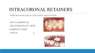 TREATMENT PLANNING FOR FIXED PROSTHODONTICS CONVENTIONAL BRIDGES AND DIAGNOSTIC WAX UP [upl. by Nive476]