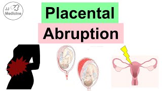 Placental Abruption Abruptio Placentae Risk Factors Symptoms Complications Diagnosis Treatment [upl. by Ahern]