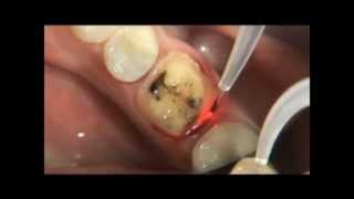 PHILIPS LASERS Eviction gingivale 3wmv [upl. by Itirp119]