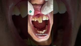 Discolored tooth Dr Aastha Khadka Dentistdiscoloration teeth swasthyapharmacy dentist short [upl. by Nonnair420]